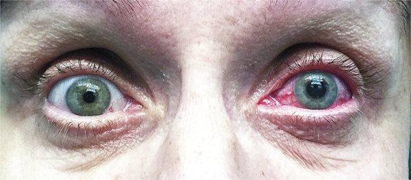 کووید-19 می تواند چشم ها را هم آلوده کند؛ بروز آب سیاه چشم در یک بیمار